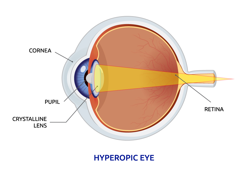 hyperopic eye