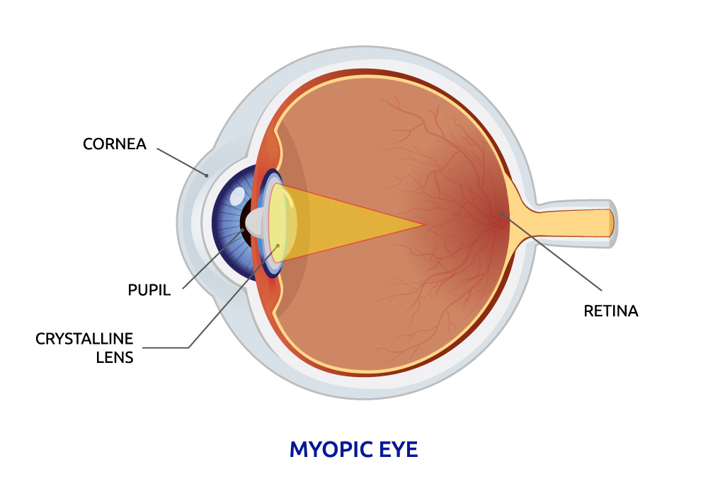 Myopic eye