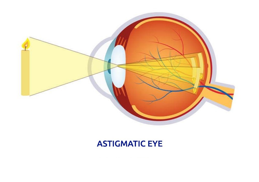 Astigmatic eye