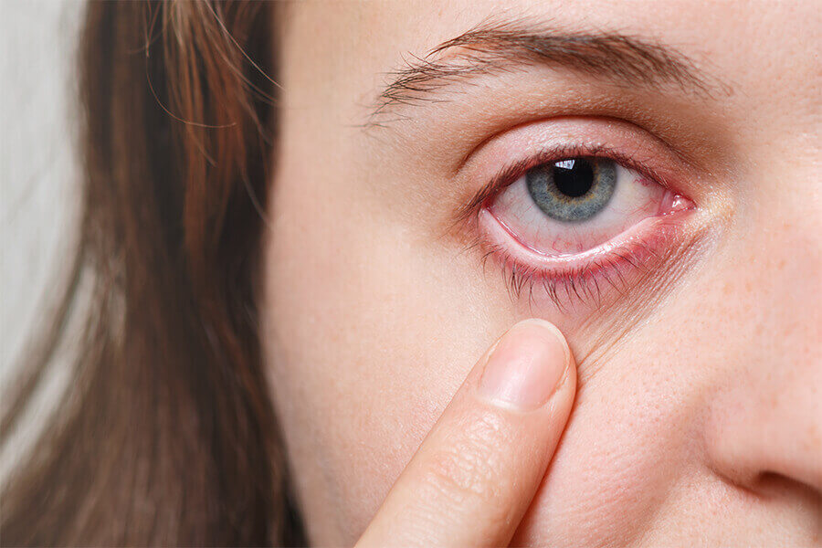 HOW DO ALLERGIES AFFECT YOUR EYES?